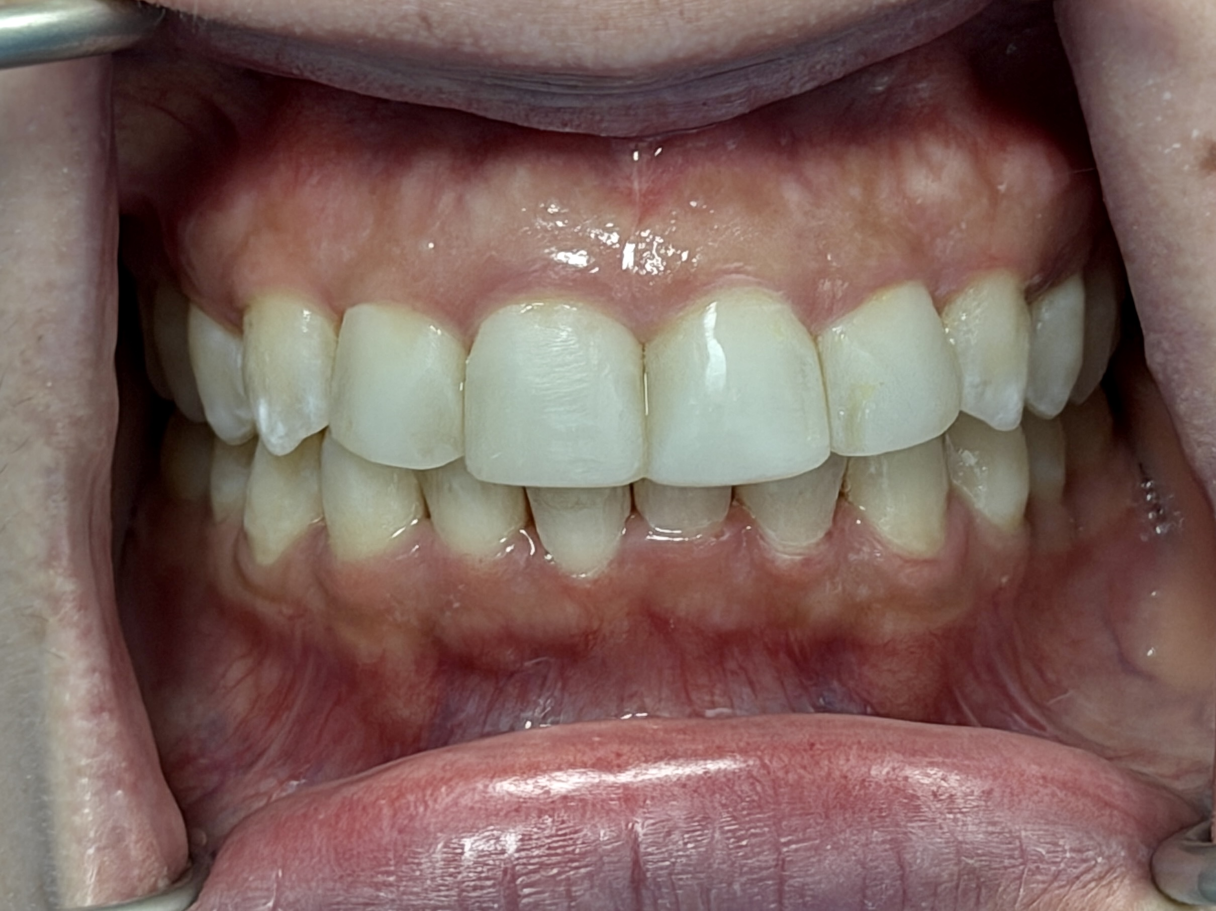 After image