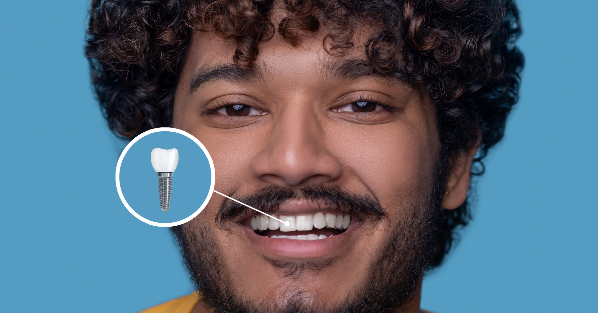 dental implants vs bridges whats better